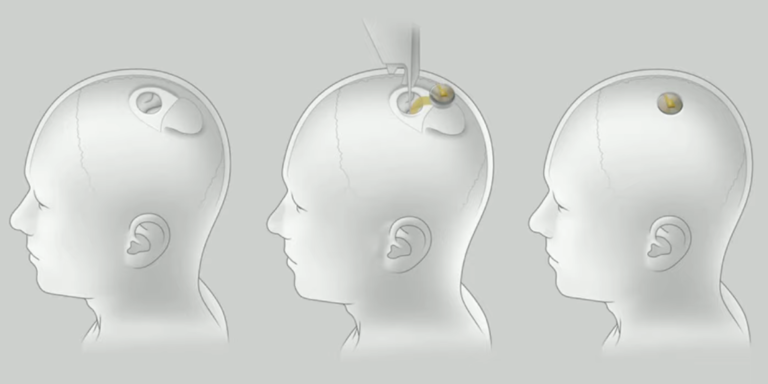 ProBeat: Hey Elon Musk, how do I get this Neuralink out of my skull ...